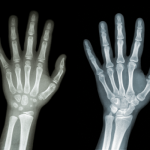 How Does Growth Plate Reveal Your Chance to Grow Taller?