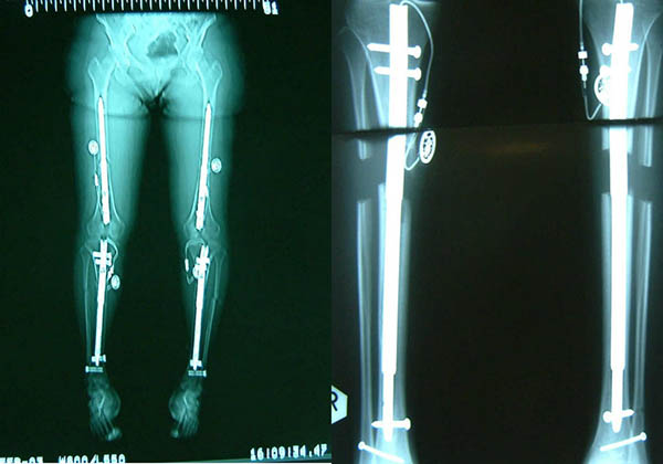 Is-leg-lengthening-surgery-safe